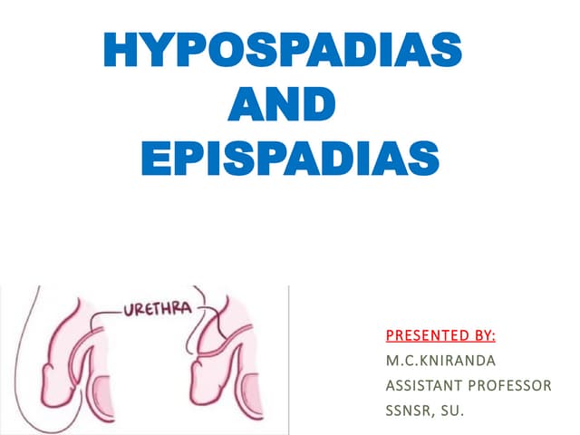 Hypospadias & epispadias | PPTX