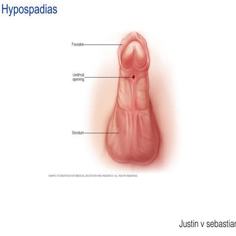 Hypospadias &amp; epispadiasis