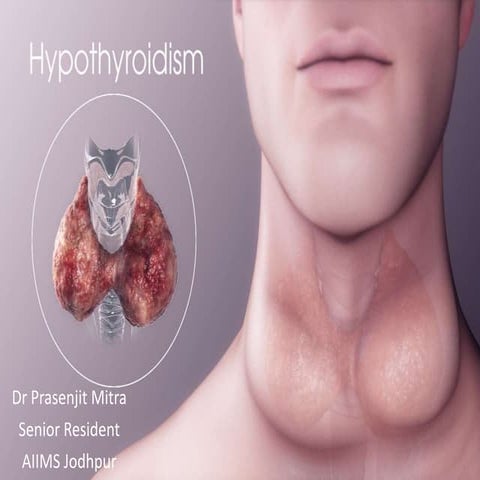 Hypothyroidism case presentation