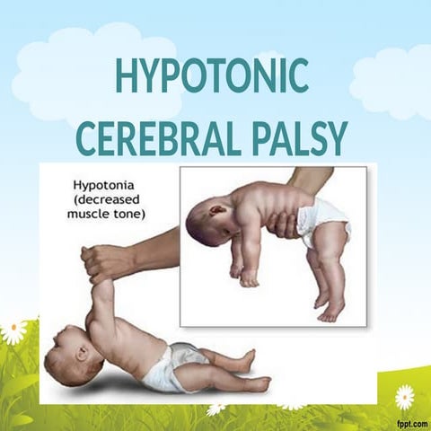 Spastic Diplegia as a spastic type of cerebral palsy for physiotherapy ...