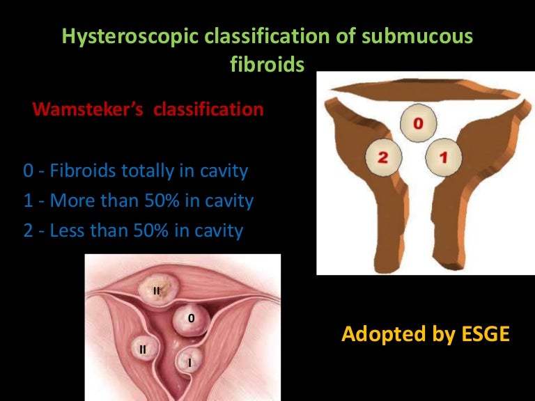 Submucous Fibroid Polyp , What Is a Submucosal Fibroid and How Can It ...