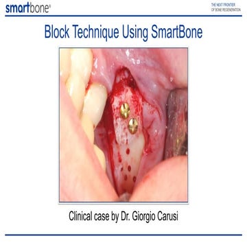 Block technique using SmartBone