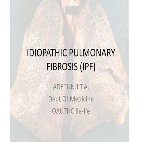 Idiopathic pulmonary fibrosis   copy
