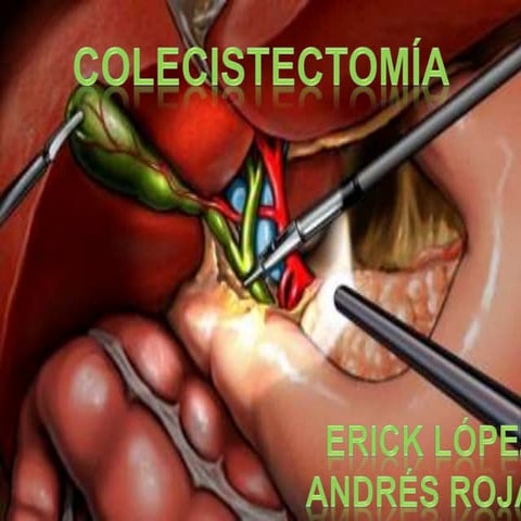 Colecistectomia