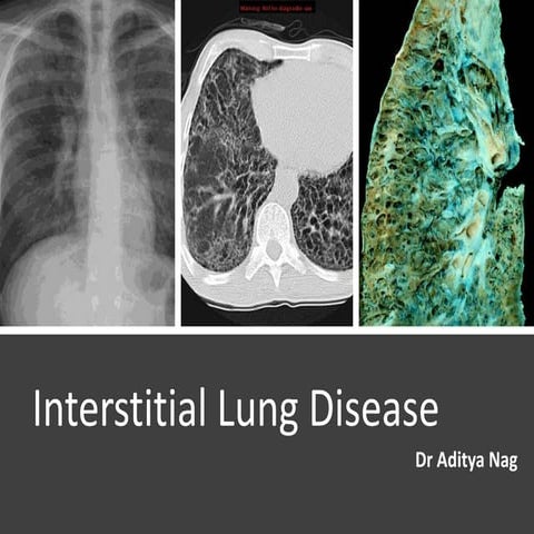 Interstitial Lung Disease ( ILD)