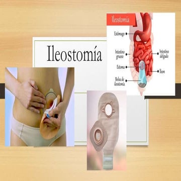 Ileostomía.............................. | PPTX