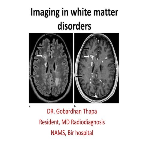 Imaging in white matter disorders | PPTX