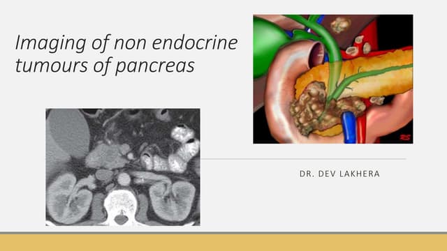 Imaging of non endocrine tumour of pancreas
