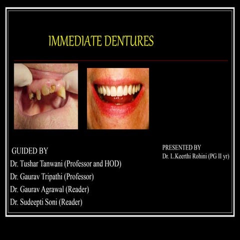 Immediate Dentures.ppt..................