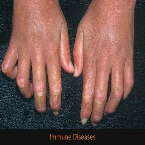 Immune diseases