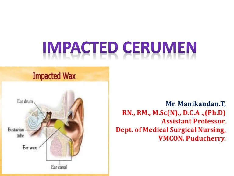 Impacted cerumen