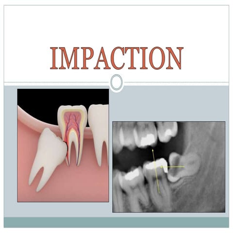 Impaction