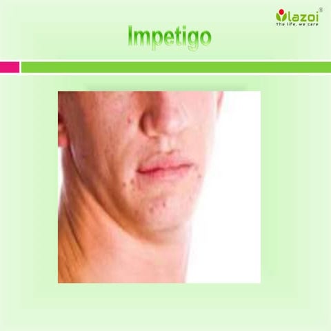 Impetigo