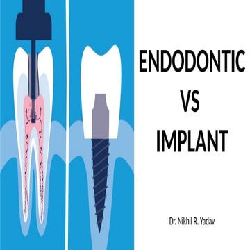 Implant_vs_RCT_Presentation ………………:.:.:: | PPTX