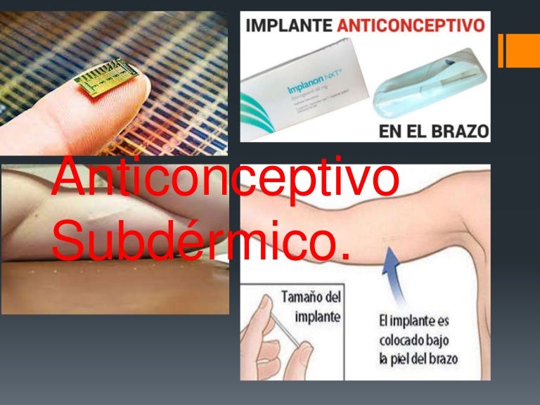 efectos secundarios del anticonceptivo implante