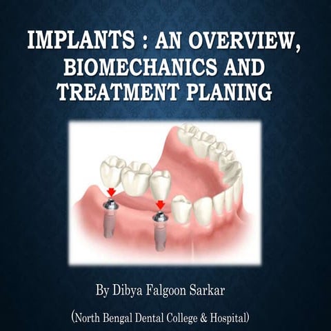 Implants : An Overview, Biomechanics & Treatment Planning