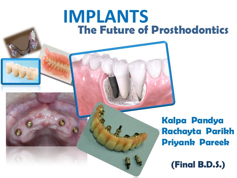 Implants the future of prosthodontics