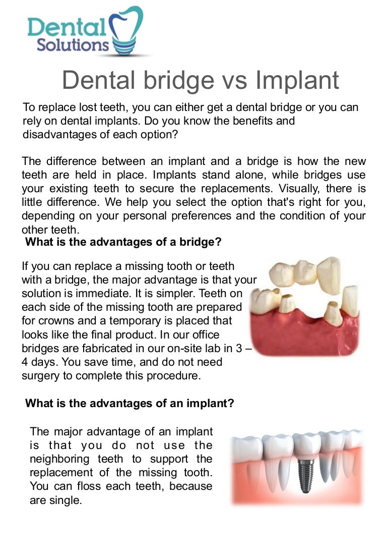 Partial Dentures Vs Implants Cost  - The Materials You Need To Make The Implant And The Other Tests That You Might Need Add To The.
