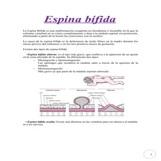 Imprimir 2 espina bifida