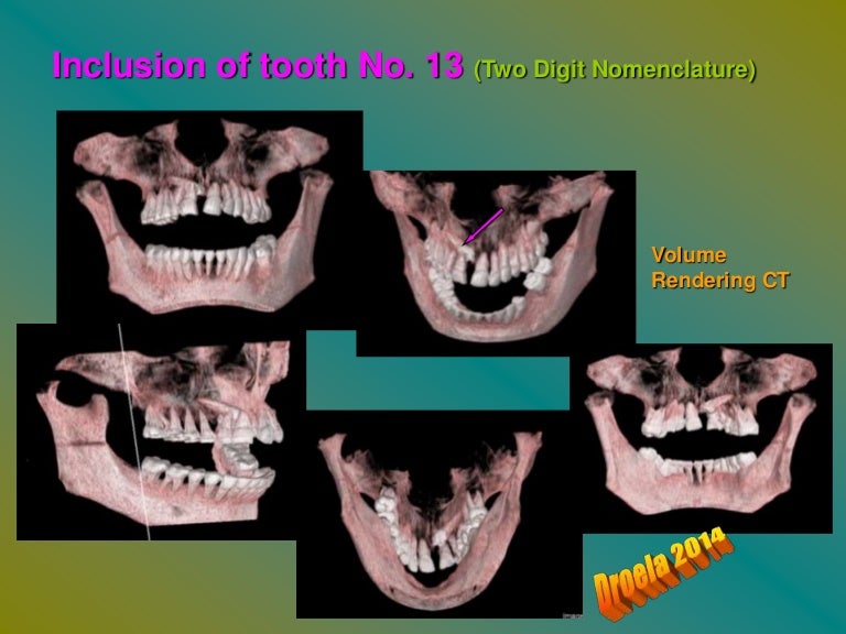 Inclusión of tooth No.13 CT