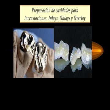 6. Preparaciones Onlay y Overlay preparacion para incrustaciones .pptx