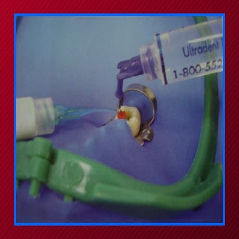 Indicaciones endodonticas