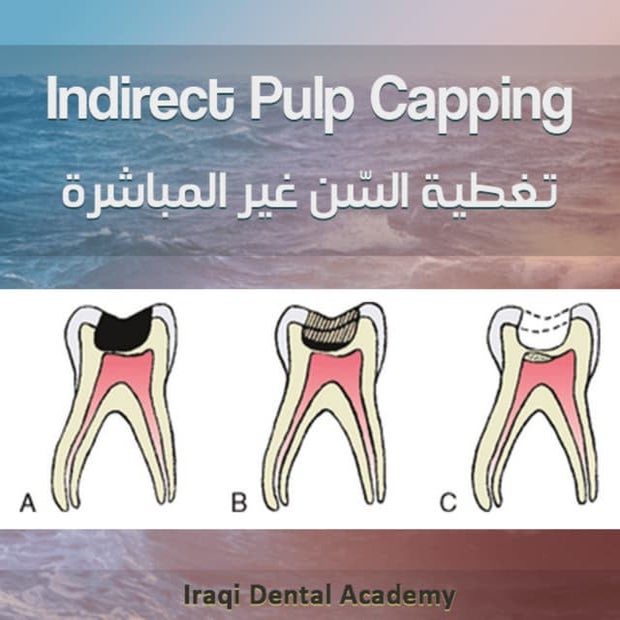 Indirect Pulp Capping Procedure PPT