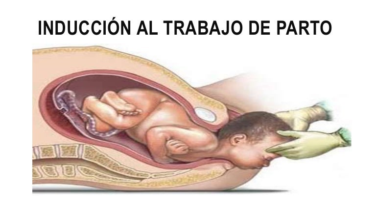 diabetes tipo 1 e inducción del parto con misoprostol diabetes tipo 1 e inducción del parto con misoprostol