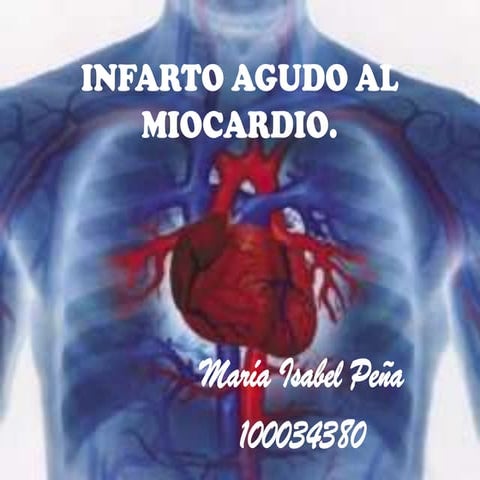 Infarto Agudo al Miocardio