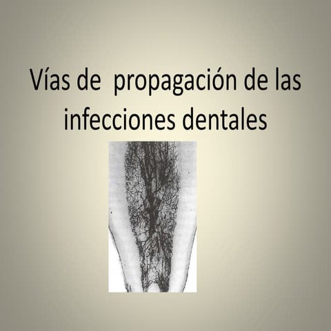 Infecciones dentales