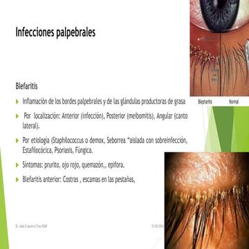 Infecciones palpebrales 