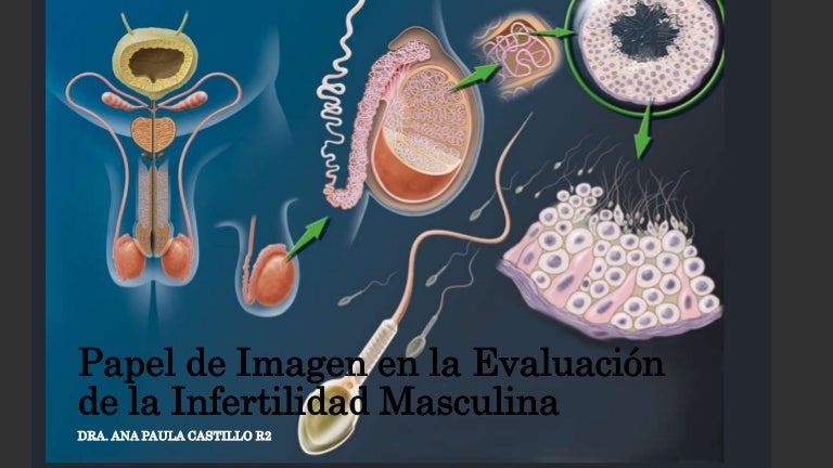 quiste en la disfunción eréctil testicular