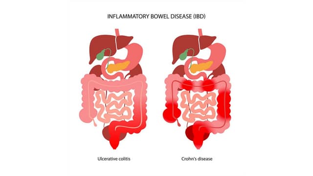 Inflammatory Bowel Diseases Presentation pptx irritable-bowel-syndrome-causes