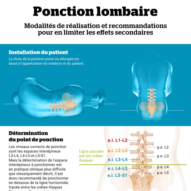Ponction lombaire. Modalités de réalisation et pour en limiter les effets