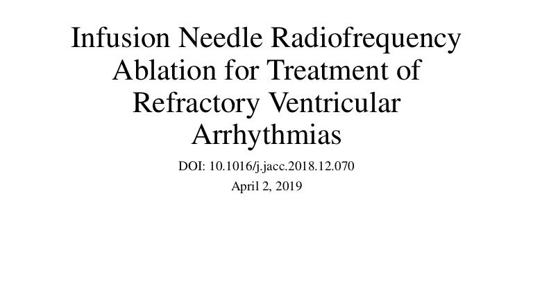 Infusion Needle Radiofrequency Ablation For Treatment Of Refractory V