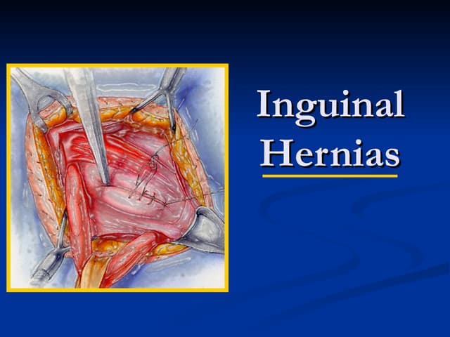 Inguinal and femoral hernia | PPTX