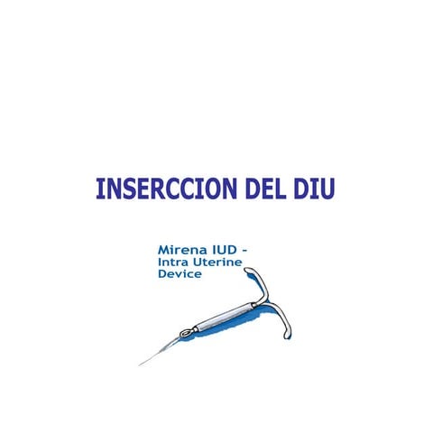 Insercción de un DIU