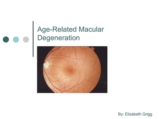 Age related macular degeneration | PPTX