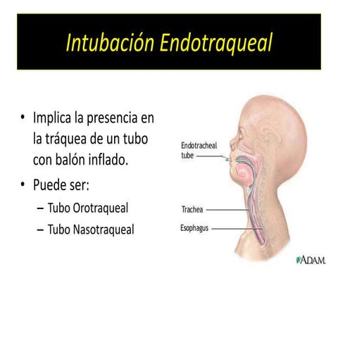 Intubacion  endotraqueal exposicion