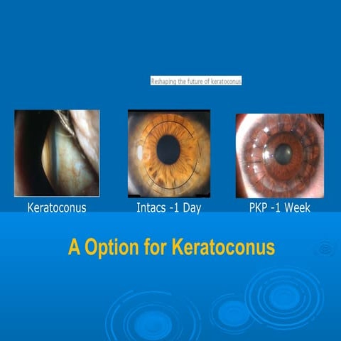 Intacs, Corneal inserts for treatment of keratoconus and ectasia