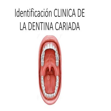 IDENTIFICACION CLINICA DE LA DENTINA CARIADA | PPTX