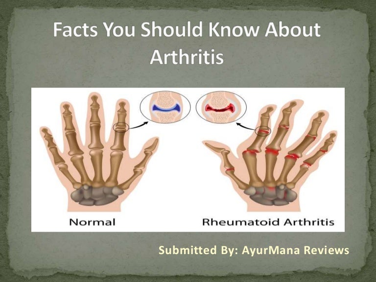 Facts You Should Know About Arthritis AyurMana Reviews