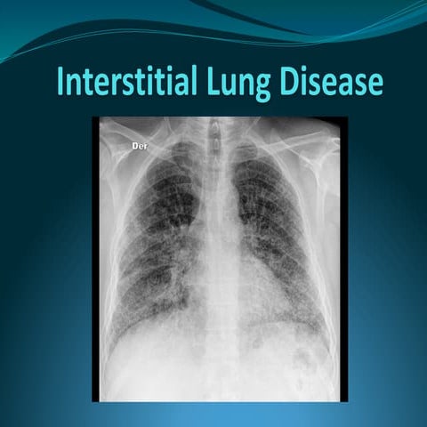 interstitial lung disease (ilD) | PPT
