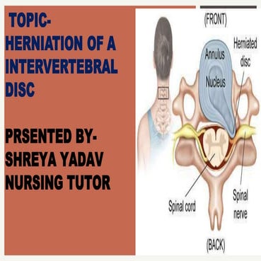 Intervertebraldiscprolapseivdp 171013100709-converted