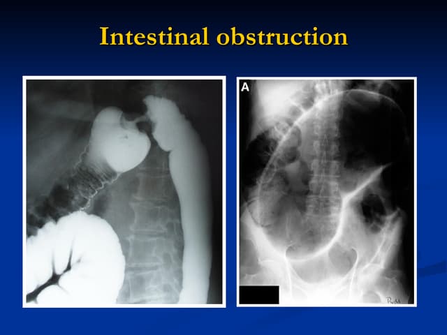 intestinal obstruction | PPTX