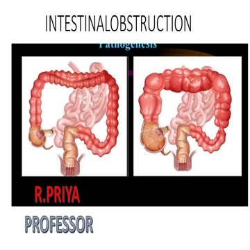 Intestinal obstruction | PPTX