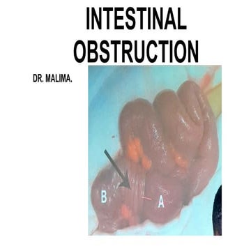 Intestinal obstruction | PPTX