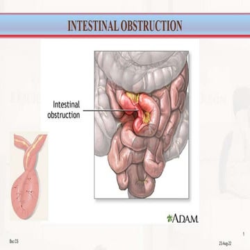 INTESTINAL OBSTRUCTION -EBM.pptx