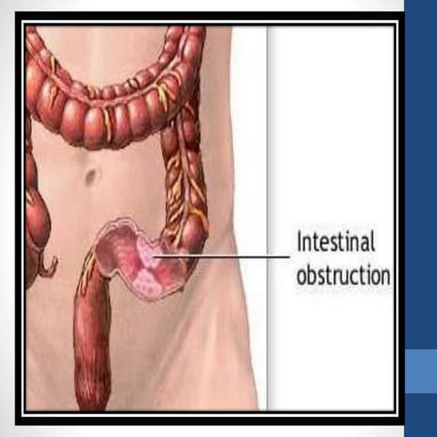 Intestinal obstruction | PPTX