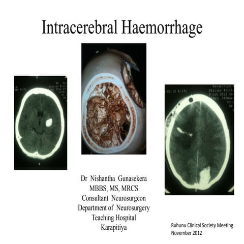 Intracerebral Haemorrhage.Dr NG NeuroEdu